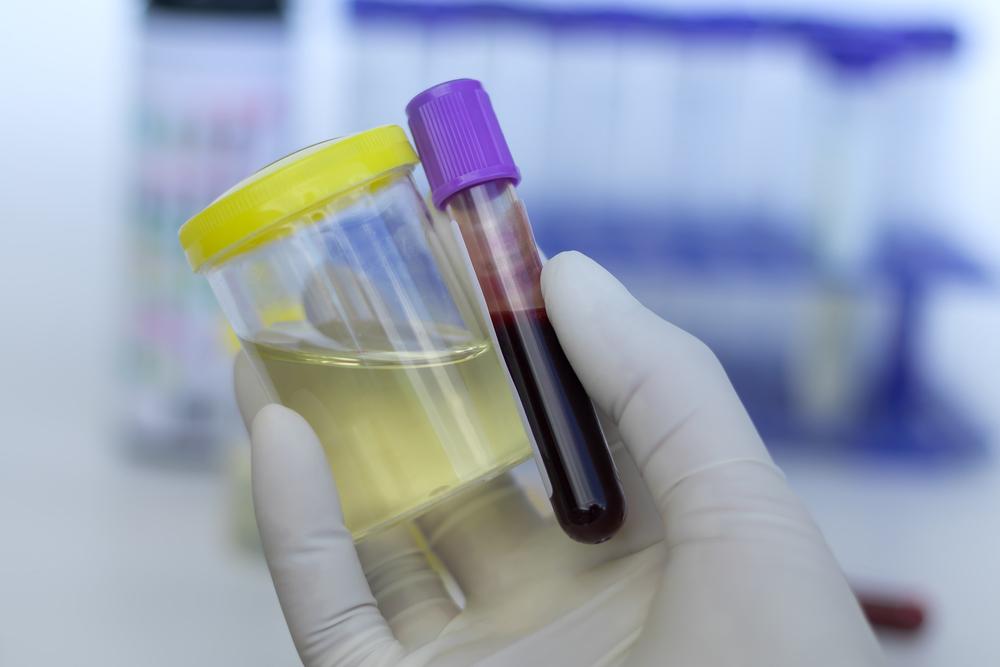 Gloved hand holding urine and blood sample.